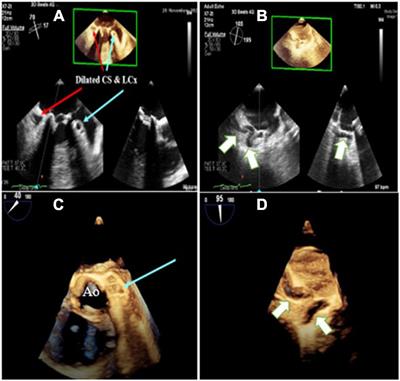 Frontiers Case Report Multimodal Imaging Diagnosis Of A Giant